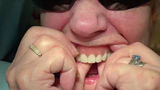 How To Reline Overdenture In Office Implants Overdenture [upl. by Melburn]