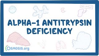 Alpha1 Antitrypsin Deficiency  causes symptoms diagnosis treatment pathology [upl. by Aihsak947]