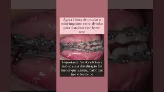 Efeitos colaterais ao utilizar mini implantes extraalveolares odontologia ortodontia [upl. by Aztinay]