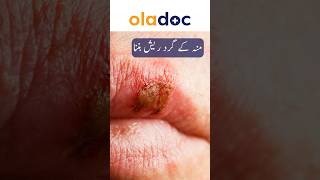 Facial Herpes How To Treat  Oral Herpes Prevention  Mouth Sores Ka Ilaj shorts youtubeshorts [upl. by Nerrat627]