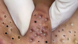 Big Cystic Acne Blackheads Extraction Whiteheads amp Blackheads Removal Pimples Popping119 [upl. by Aivatnohs880]