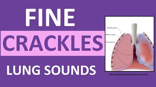 Crackles Fine Lung Sounds  Crackles and Rales Breath Sounds Abnormal [upl. by Tabshey]