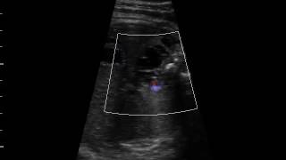 Lymphangiome thoraco abdominal [upl. by Noeht]