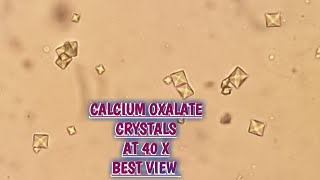 Calcium Oxalate crystals in urine routine microscopyCaOxlate 40X Acidic crystals in urine [upl. by Popele178]