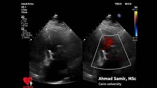 Transvalvular pacemaker in a case with tricuspid bioprothesis  Ahmad Samir [upl. by Ahseret]