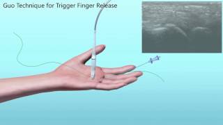 Trigger Finger Release [upl. by Aynat8]