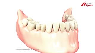 3 Unit Bridge On Teeth  Nobel Biocare [upl. by Collier518]