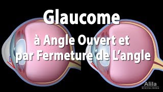 Pathologie du Glaucome Animation [upl. by Crescen944]