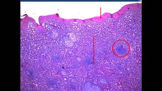 Sarcoidosis Rhino Actinomycosis Leprosy FB 2024  jars and slides [upl. by Aerdnahc]