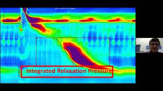 Oesophageal dysmotility cases  simplifying manometry interpretation  Dr M Scriba [upl. by Bald351]