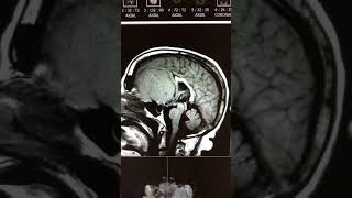 Cribriform plate meningioma [upl. by Ased]