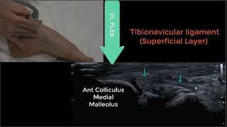 Deltoid Ligament Ultrasound 2023 [upl. by Farris103]