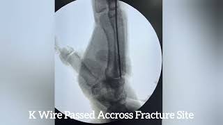 CRIF WITH ANTE GRADE CRIF K WIRE FIXATION FOR 3RD METACARPAL SHAFT FRACTURE IN A YOUNG MALE [upl. by Sessylu144]