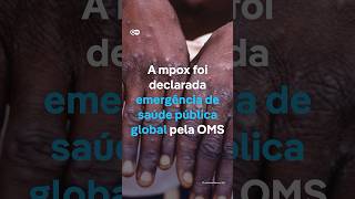 Mpox emergência de saúde global  shorts [upl. by Lagas]