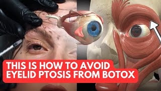 Avoid Eyelid Ptosis From Botox Treatments with THIS Anatomy Knowledge [upl. by Ratcliff]