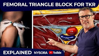 Femoral Triangle Block For TKR [upl. by Darom]