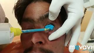 IMPRESSION FOR OCULAR PROSTHESIS [upl. by Aiciled]