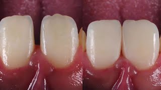 Diastema Closure using composite diastema [upl. by Waylin495]