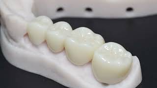 Types of Dental Crowns and Materials  Gold Porcelain Lithium Disilicate amp Zirconia [upl. by Wendall]