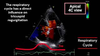 Tricuspid Regurgitation and Respiratory Cycle [upl. by Sedlik192]