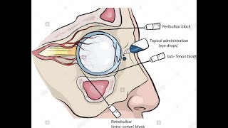 Peribulbar and retrobulbar Block for eye surgery [upl. by Howlond]