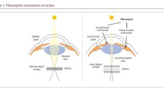 Using Muscarinic Agonist drugs Pilocarpine to treat Glaucoma [upl. by Ydnar30]