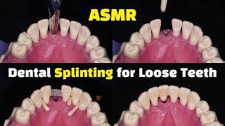 Dental Splinting for Loose Teeth using Ribbond after a Tooth Extraction [upl. by Haldan]