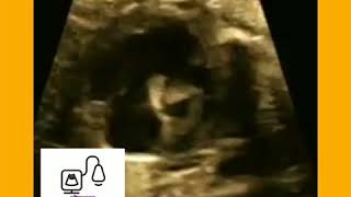 Fetal Echocardiography [upl. by Floris]