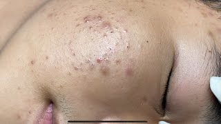 ACNE TREATMENT VU QUYNH MI  Perennial Blackheads On Boy Face 2024FULL [upl. by Birecree133]