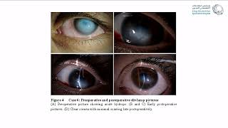 Corneal Hydrops Rethinking Treatment [upl. by Ecam498]