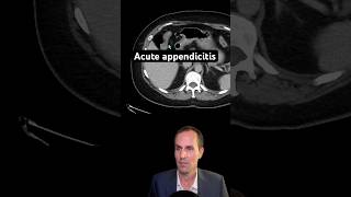 Abdominal CT Tutorials  Acute appendicitis [upl. by Eilsek]