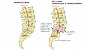 Med Educational Lumbar Spondylolisthesis Grade 1 and 2 [upl. by Einafets]