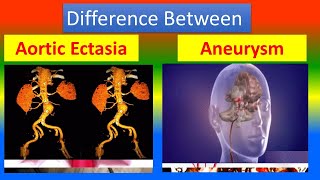 Difference between Aortic Ectasia and Aneurysm [upl. by Sena]