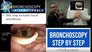 Bronchoscopy Step by Step Walkthrough 16 [upl. by Okeim]