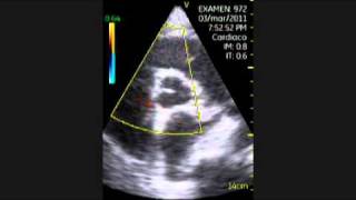 VSCAN Cardiomyopathy of Hypothyroidism Pocket ultrasound Cardiopatía en hipotiroidismo [upl. by Akilak868]