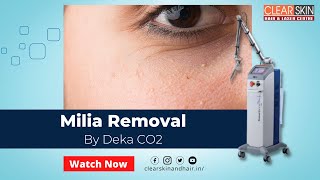 How to Remove Milia Permanently  Milia Removal Treatment by Deka CO2 Laser  Causes amp Symptoms [upl. by Fidole597]