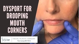 Dysport Injections to DAO Muscle for Drooping Mouth Corners [upl. by Palua]