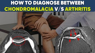 Chondromalacia vs Osteoarthritis of kneewhat’s the difference drpankajwalecha [upl. by Cresa103]