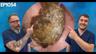 Removing Massive Ear Wax Blockages  EP1054 [upl. by Liagabba]