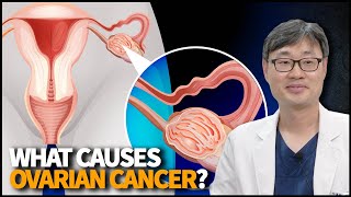 What Causes Ovarian Cancer How to Detect it Early and How to Treat it [upl. by Orlantha]