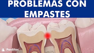 Problemas con empastes – La obturación dental desbordada © [upl. by Gavrielle]