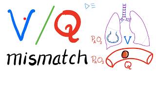 Ventilation Perfusion Ratio VQ and VQ Mismatch  Respiratory Physiology amp Pulmonology [upl. by Atcliffe677]