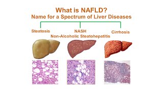 What is NonAlcoholic Fatty Liver Disease NAFLD [upl. by Cade]