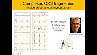 3c Les QRS fragmentés Valeur diagnostique et pronostique P Taboulet [upl. by Bully]