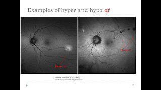 Best practices for utilizing FAF amp UWF retinal imaging in the optometric practice [upl. by Namrehs]