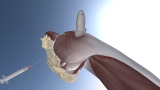 3D Model of Ultrasound Guided Greater Trochanteric Bursitis Injection by probeultrasound [upl. by Trepur]