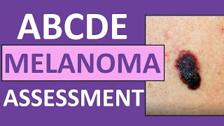 ABCDE Melanoma Skin Cancer Assessment Nursing with Pictures [upl. by Ed]