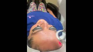 Co2 laser hyperplasia sebaceous co2laser blackheads extractionsatisfaction [upl. by Akenor]