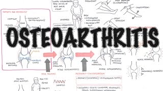 Osteoarthritis Overview causes pathophysiology investigations treatment [upl. by Keemahs]