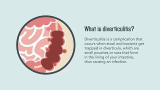 Diverticulitis Signs Symptoms Causes and Treatment  Merck Manual Consumer Version Quick Facts [upl. by Parthenia]